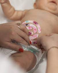 Тейпування грижі пупочного кільця у немовлят